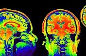 neuro1